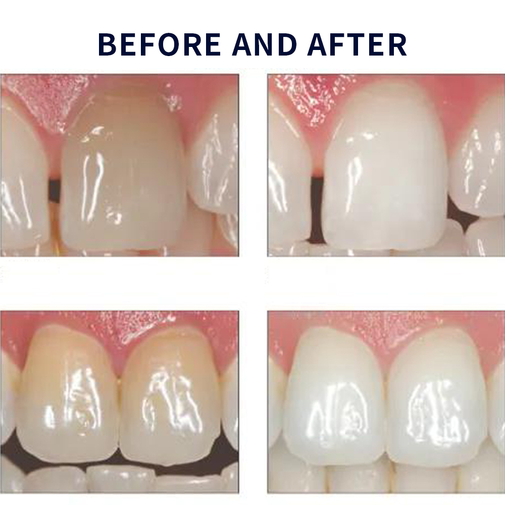 Opalescence Whitening 20% PF 2 - đánh giá và giá Teeth Whitening In Office