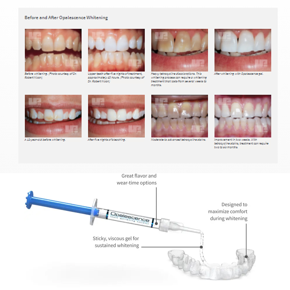 Opalescence Whitening 20% PF 2 - đánh giá và giá Teeth Whitening In Office