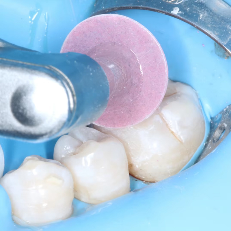 40Pcs Dental Polishing Disc Co - đánh giá và giá Teeth Whitening Express