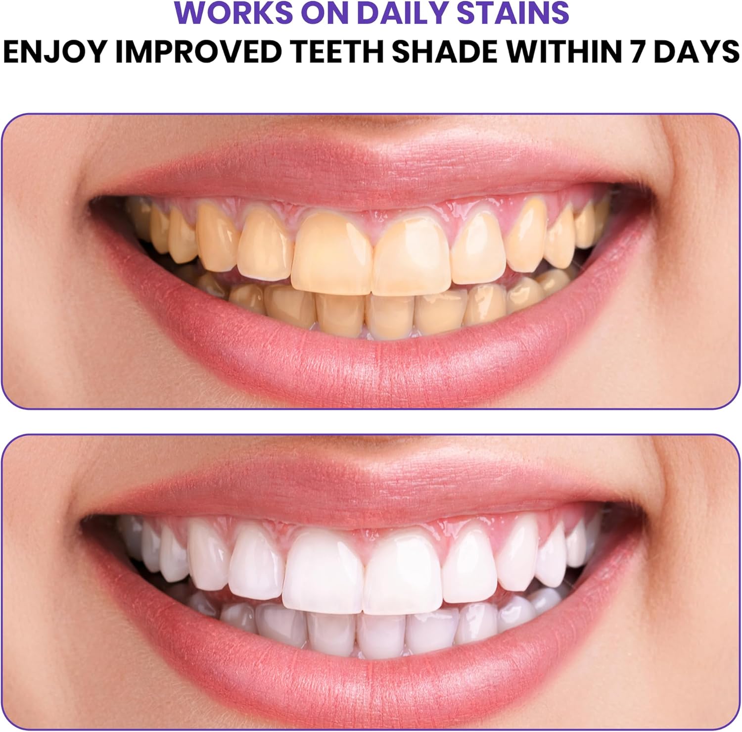 Advanced Purple Teeth Whitenin - đánh giá và giá Teeth Whitening In Office