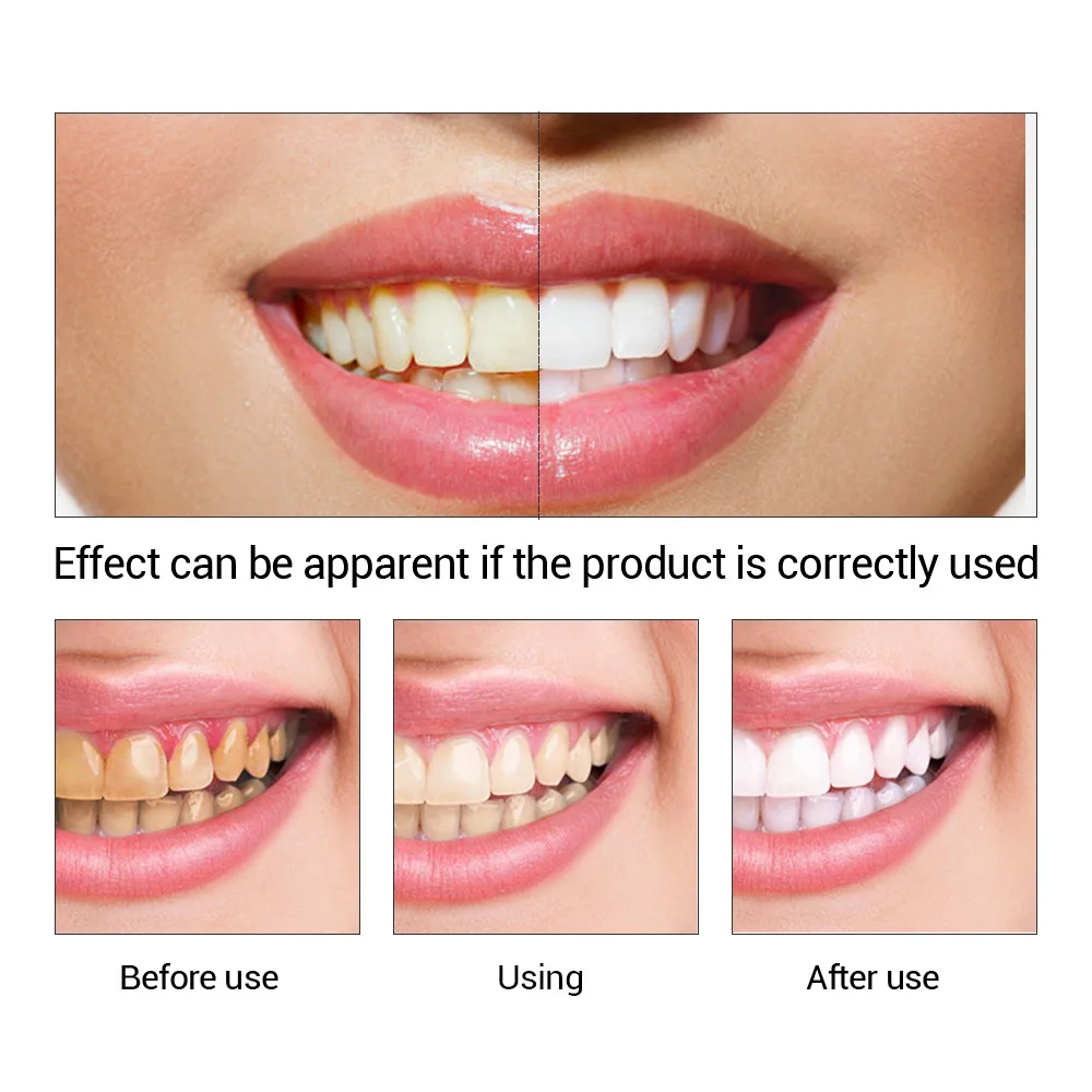 FTEENPLY Làm Trắng Răng Tinh C - đánh giá và giá Teeth Whitening Hismile