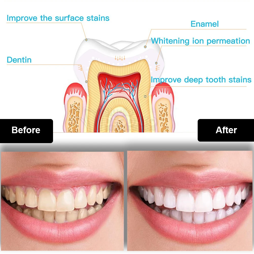 Dental Teeth Whitening Kit Min - đánh giá và giá Teeth Whitening With Blue Light