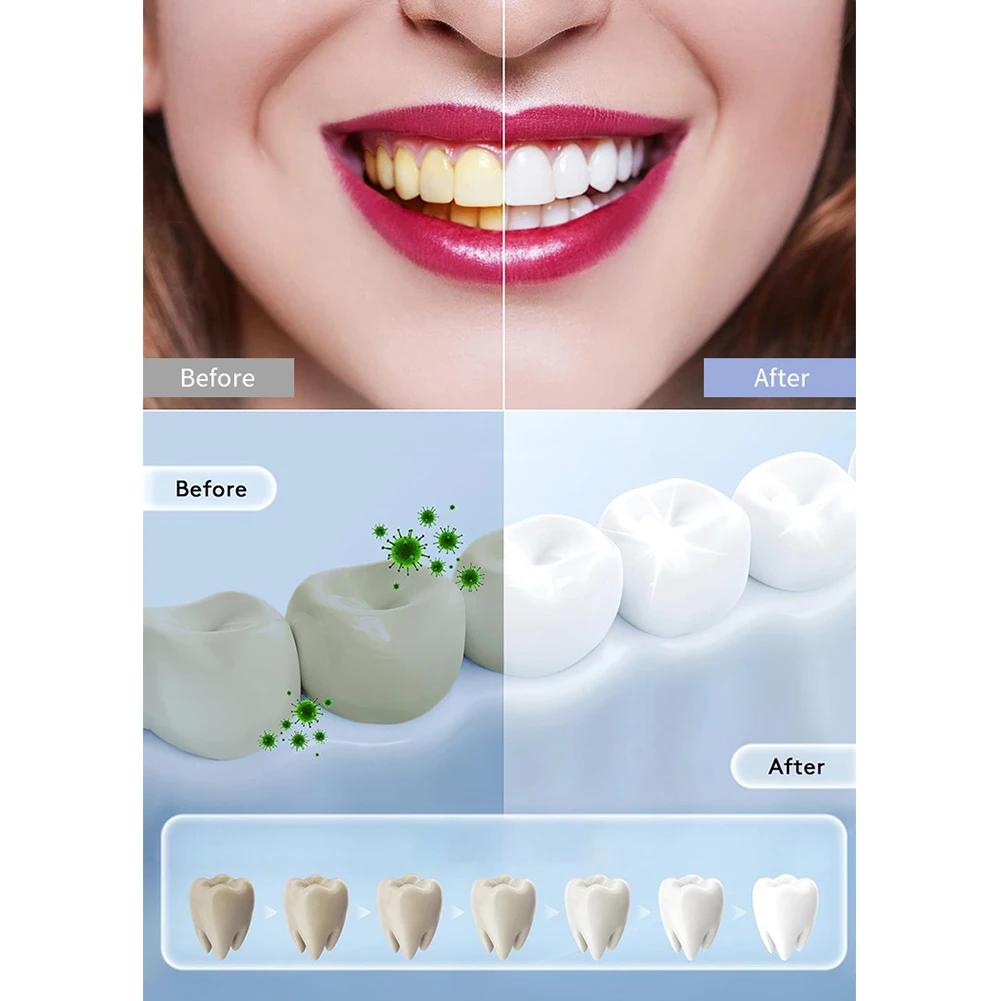 1PC Household Smart LED Teeth  - đánh giá và giá Teeth Whitening In Office